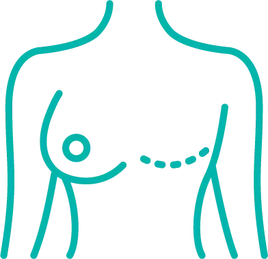 Illustration of breasts demonstrating a mastectomy and reconstruction